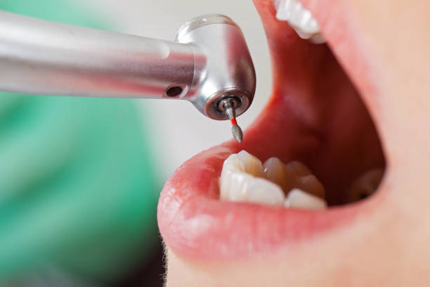 Best Emergency Tooth Extraction in Ruston, LA